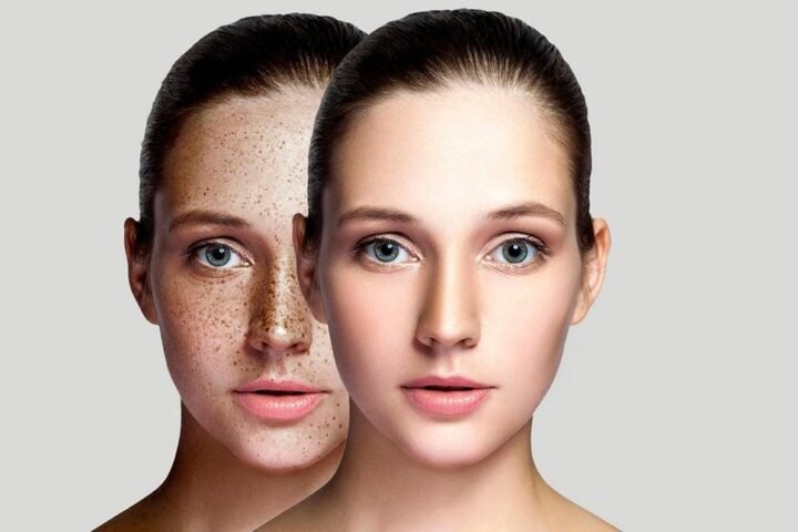 remove dark spots naturally