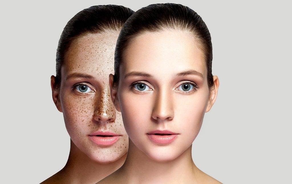 How to Get Rid of Dark Spots Naturally