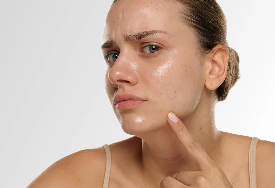 Complete Skincare Routine for Oily Skin (2026)